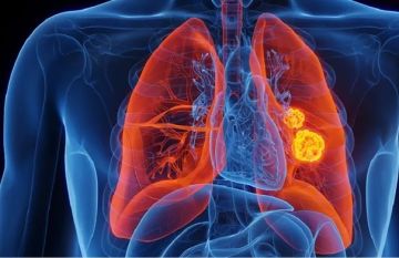 عرض صحي قد يكون مؤشرا على الإصابة بسرطان قاتل عرض صحي قد يكون مؤشرا على الإصابة بسرطان قاتل