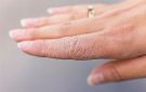 بشرتك تكشف الخطر.. علامات مبكرة للسكري تظهر على الجلد - jo