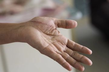 مظهر الندبة يزعجك؟ إليك الحل