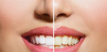 من لقمة واحدة إلى تسوس سريع ماذا يفعل السكر بأسنانك؟