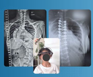 انجازا طبيا جديد في قسم جراحه العمود الفقري انجازا طبيا جديد في قسم جراحه العمود الفقري