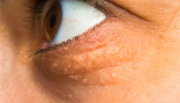 علامتان في الوجه تكشفان عن ارتفاع مستوى الكوليسترول