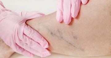 تحذير طبي: جلطة الساق ومخاطرها القاتلة تحذير طبي: جلطة الساق ومخاطرها القاتلة