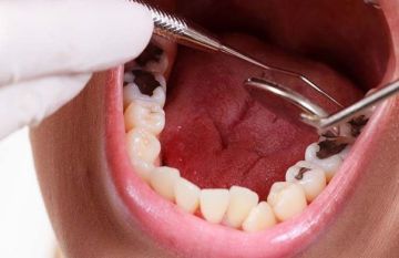 من الدقيقة الأولى.. هكذا يبدأ السكر بإضعاف الأسنان!