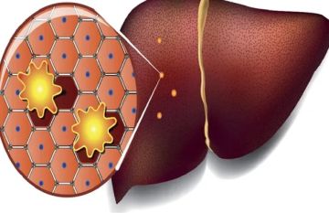 النظام الغذائي الغني بالدهون قد يهيئ الكبد للإصابة بالسرطان