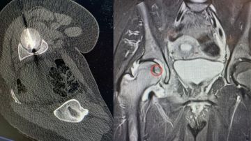 تدخل علاجي نوعي في مستشفى الجامعة لعلاج ورم في رأس عظم الفخذ