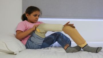 ارتفاع حاد في حالات بتر الأطر اف بمستشفيات غزة بسبب نقص المضادات الحيوية ارتفاع حاد في حالات بتر الأطر اف بمستشفيات غزة بسبب نقص المضادات الحيوية