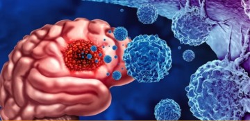 أورام الدماغ بين الأولية والثانوية وهذه أبرز الإشارات التحذيرية