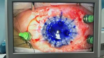 عملية نوعية مركبة في قسم العيون في مستشفى الملك المؤسس