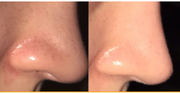 الرؤوس السوداء في الأنف: الأسباب وأفضل الطرق الطبيعية للتخلص منها الرؤوس السوداء في الأنف: الأسباب وأفضل الطرق الطبيعية للتخلص منها