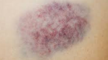 هل ظهور الكدمات المفاجئة ناقوس خطر يجب معالجته؟