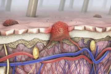 مكان غير متوقع قد يظهر فيه سرطان الجلد الميلانيني