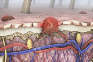 مكان غير متوقع قد يظهر فيه سرطان الجلد الميلانيني مكان غير متوقع قد يظهر فيه سرطان الجلد الميلانيني