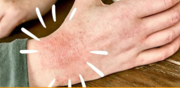 نصائح للتخلص من مشكلة إكزيما الشتاء.. هذا ما يجب فعله