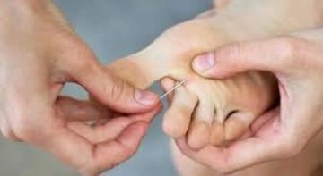 الشظايا تحت الجلد.. كيف يمكن علاجها في المنزل؟