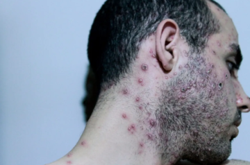 الصحة الاسرائيلية تعلن تسجيل أول حالة بجدري القرود