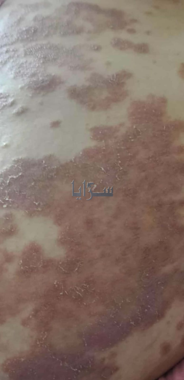 أمام الجهات المعنية .. مناشدة إنسانية لتوفير تكاليف علاج ليزر لسيدة تعاني من مرض غامض