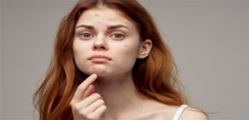 لماذا يزداد حب الشباب في الشتاء؟ حلول فعالة للحفاظ على صحة البشرة