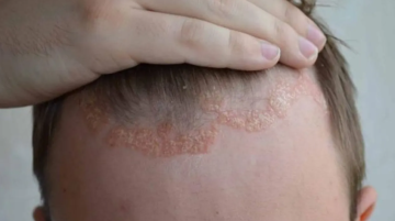 دواء مناعي يمنع عودة الصدفية دواء مناعي يمنع عودة الصدفية