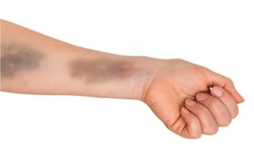 الكدمات العشوائية على الجسم.. متى تستدعي القلق؟