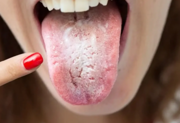 الذكاء الاصطناعي يشخص السكري وسرطان المعدة من لون اللسان