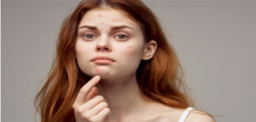 لماذا يزداد حب الشباب في الشتاء؟ حلول فعالة للحفاظ على صحة البشرة