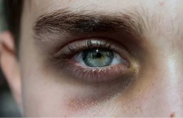 لماذا تزداد الهالات الداكنة حول العينين سوءا في الشتاء؟