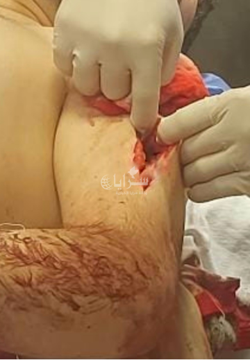 صور صادمة .. صاحب أسبقيات يطعن شابا 7 طعنات ويتسبب ببتر إصبعه و300 غرزة بعد رفض تزويجه شقيقته صور صادمة .. صاحب أسبقيات يطعن شابا 7 طعنات ويتسبب ببتر إصبعه و300 غرزة بعد رفض تزويجه شقيقته