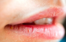 تشققات الشفاه المستمرة قد تشير إلى هذا المرض - jo