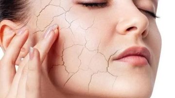 عادات صباحية تزيد جفاف البشرة شتاء.. وآخرها شائع جدا