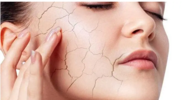 عادات صباحية تزيد جفاف البشرة شتاء.. وآخرها شائع جدا