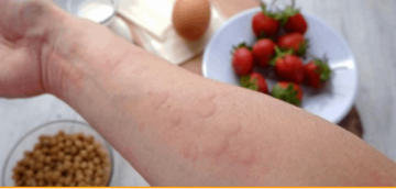 صدمة للمصابين بحساسية الفول السوداني: سحب دواء بالفورزيا حول العالم صدمة للمصابين بحساسية الفول السوداني: سحب دواء بالفورزيا حول العالم