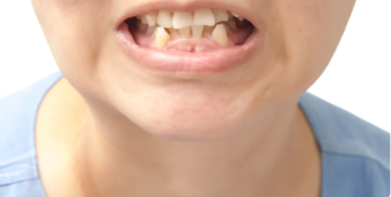 حالة طبية نادرة.. شاب يصاب بسرطان الفم بسبب أسنانه الحادة حالة طبية نادرة.. شاب يصاب بسرطان الفم بسبب أسنانه الحادة