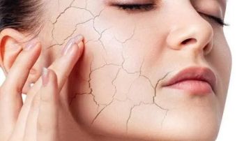 عادات صباحية تزيد جفاف البشرة شتاء.. وآخرها شائع جدا