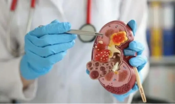 علاج مبتكر يفتح أفقا جديدا في مواجهة سرطان الكلى