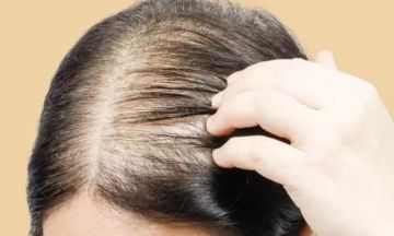 أسباب تساقط الشعر عند النساء