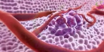 ارتفاع مقلق في اصابات السرطان بين الشباب