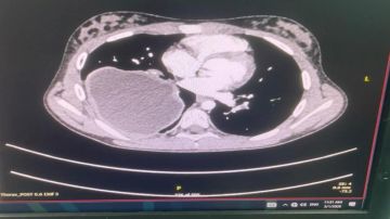 إجراء عملية نوعية في مركز الملكة علياء لأمراض وجراحة القلب