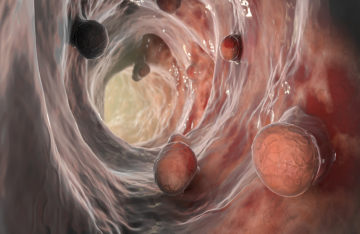 مشروبات شائعة الاستهلاك تضاعف خطر الإصابة بسرطان الأمعاء مشروبات شائعة الاستهلاك تضاعف خطر الإصابة بسرطان الأمعاء