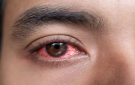 احمرار العين الشديد- علامات تحذير تتطلب الانتباه