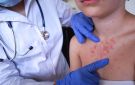 الولايات المتحدة تسجل أول وفاتين بالحصبة في عام 2026