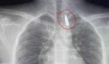 جراحة معقدة.. إنقاذ حياة طفل من غزة مصاب بمقذوف في صدره