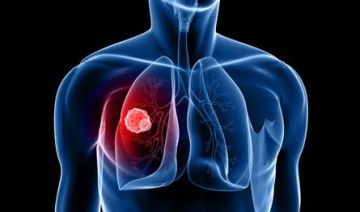 بشرى لمرضى السرطان: تقنية تعيد فعالية العلاج الكيميائي لأورام الرئة