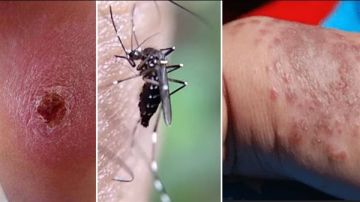 حبة حلب الخطيرة تنتشر في سوريا، فهل من خطر لوصولها الى لبنان؟