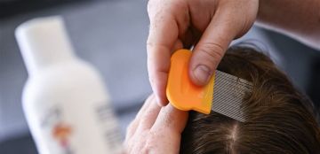 3 خطوات للتخلص من القمل.. هكذا تحمون أطفالكم