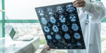 اجراءات طبية سريعة يجب اعتمادها عند حدوث الجلطة الدماغية