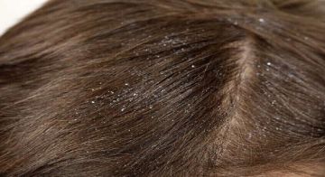 قشرة الرأس وأسبابها المتنوعة وكيفية التعامل معها بفعالية