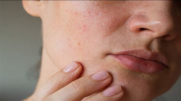 بشرتك تتحدث.. 4 علامات في الوجه تكشف إفراطك في شرب الحليب