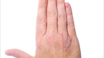 اكتشاف طريقة فعالة لتقليل أعراض الصدفية