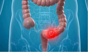احم أمعاءك.. 4 أطعمة تقلل خطر الإصابة بسرطان القولون!